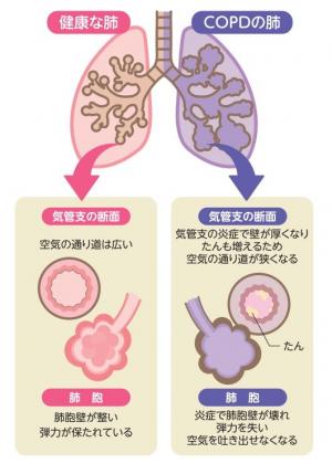 健康な肺とCOPDの肺との違い